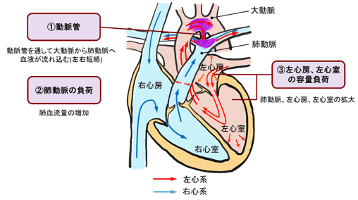 図9：動脈管開存症のメカニズム