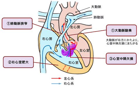 図１０：ファロー四徴症のメカニズム