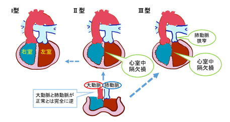 図11：完全大血管転位症の３つのタイプ