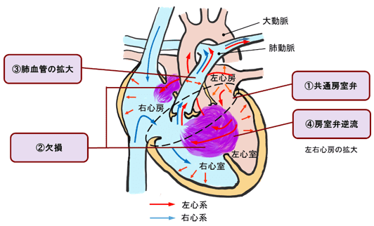 図8：房室中隔欠損症のメカニズム