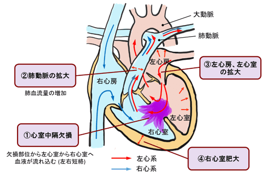 図２：心室中隔欠損症のメカニズム
