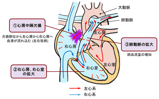 図５：心房中隔欠損症のメカニズム